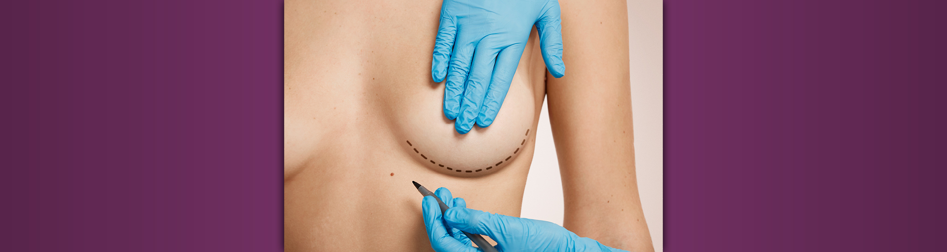 Ein Chirurg zeichnet Schnittmuster auf eine Brust.