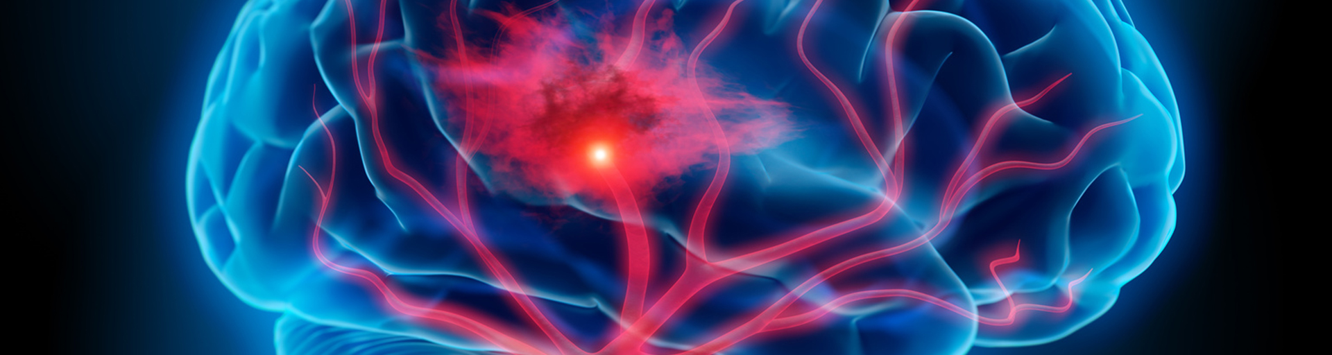 Zum Artikel: 10. Mai - Tag gegen den Schlaganfall: Schnelle Behandlung im Krankenhaus ist immer wichtig, um größere Schäden zu verhindern